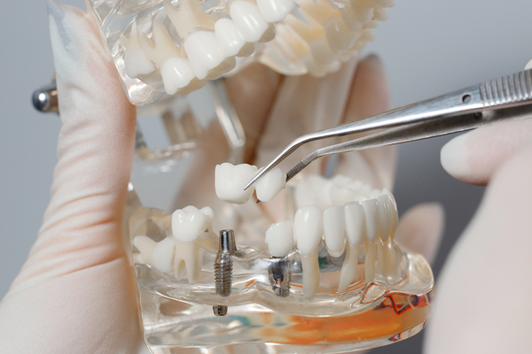 Complete Your Smile With An Implant Crown