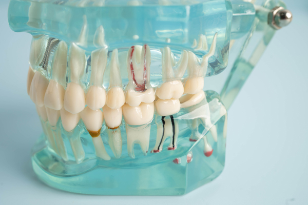 FAQs About Root Canal Treatment